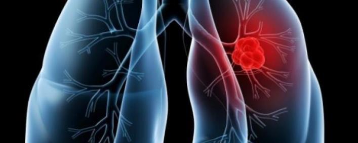 Tratament cancer pulmonar in sectia de Chimioterapie (Prezentare caz)